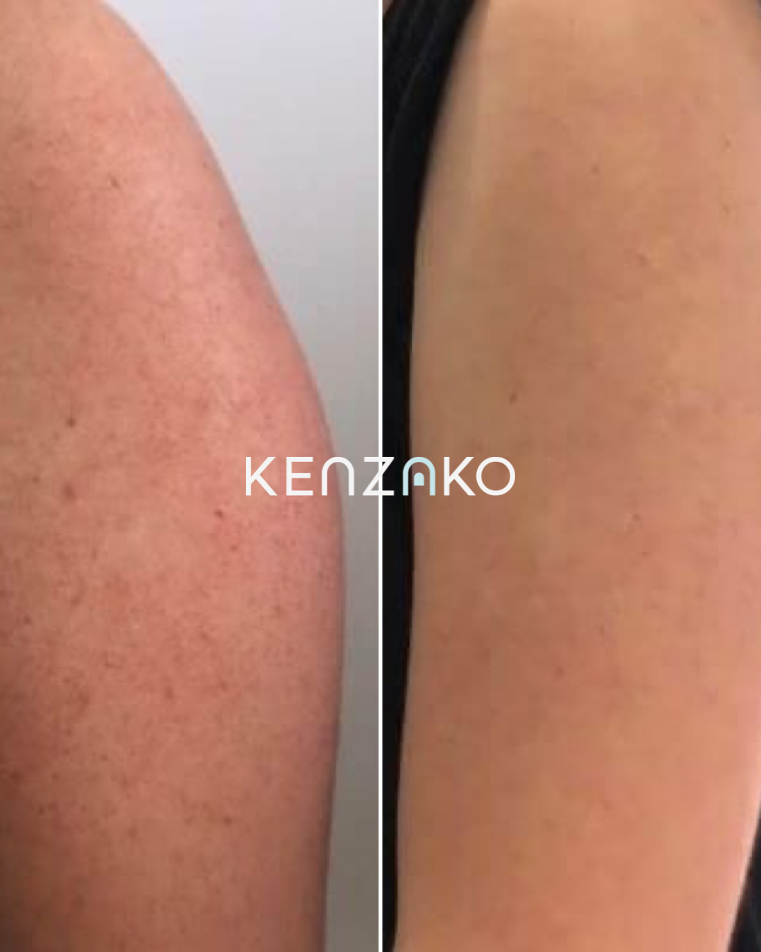 AHA Body Reset - Corrective AHA Body Exfoliant for KP & Congestion