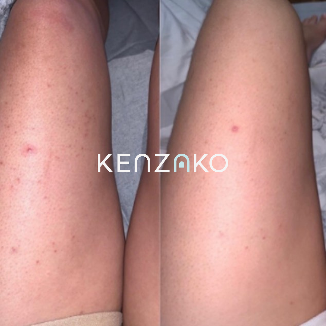 AHA Body Reset Scrub - Gentle Exfoliating Body Scrub for Body Acne. 10% AHA Formula! This is one-of-a-kind body scrub for brighter, even-toned skin from the first use. A gentle vegan body scrub that uses natural acids and beads from pumice (free from micro plastic beads) to slough off dead skin cells and restore your body to smoothness. Works from the first application to visibly make rough, dry skin a thing from the past. Ongoing use banishes dullness and promotes glowing skin.