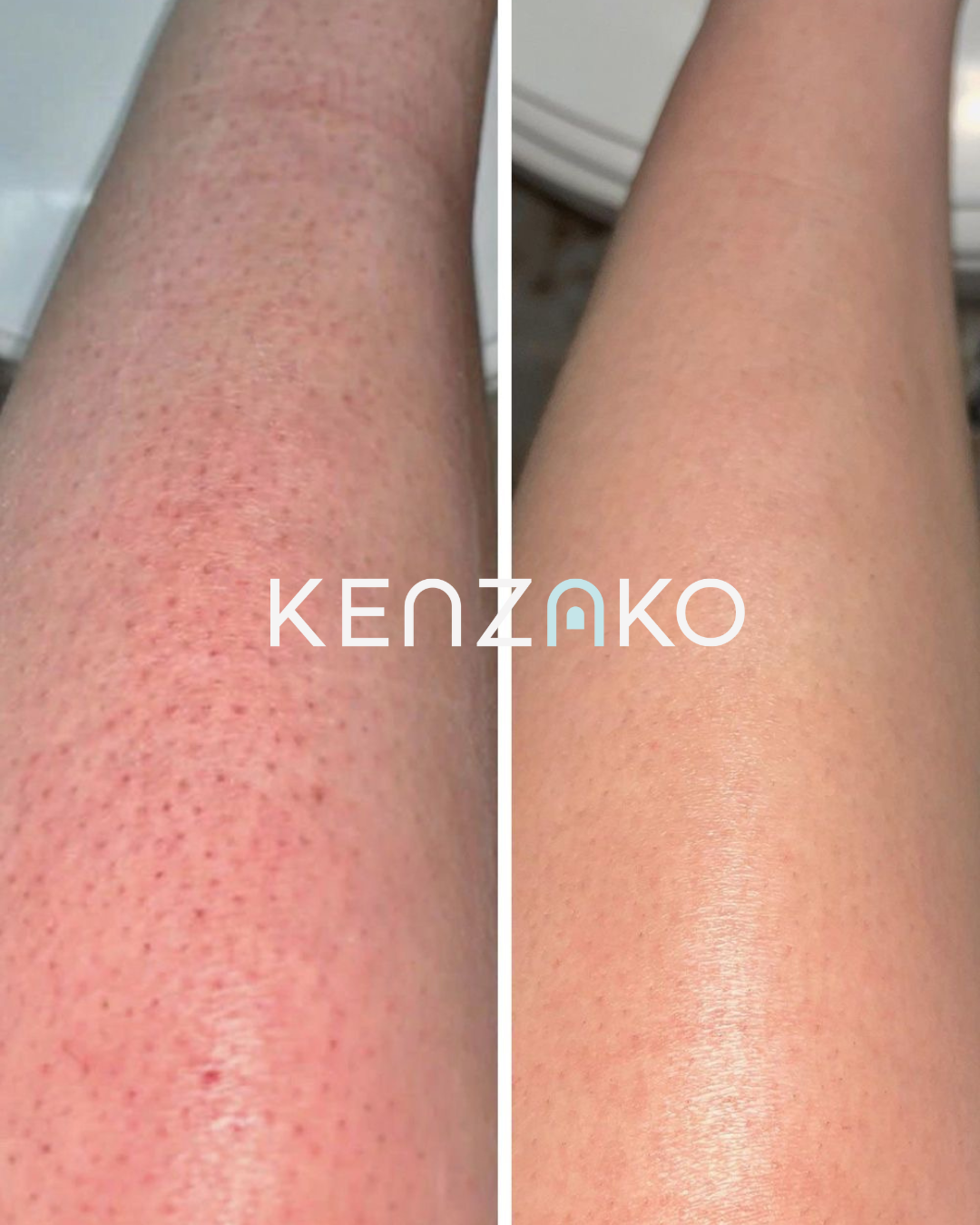 AHA Body Reset Scrub - Exfoliating Body Scrub for Smooth Skin & KP Treatment