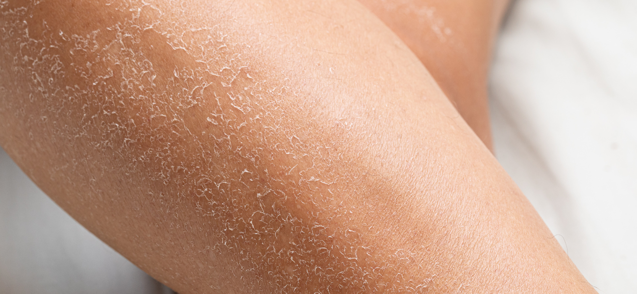The Truth About Dry Winter Skin: Why Your Moisturiser Isn't Working