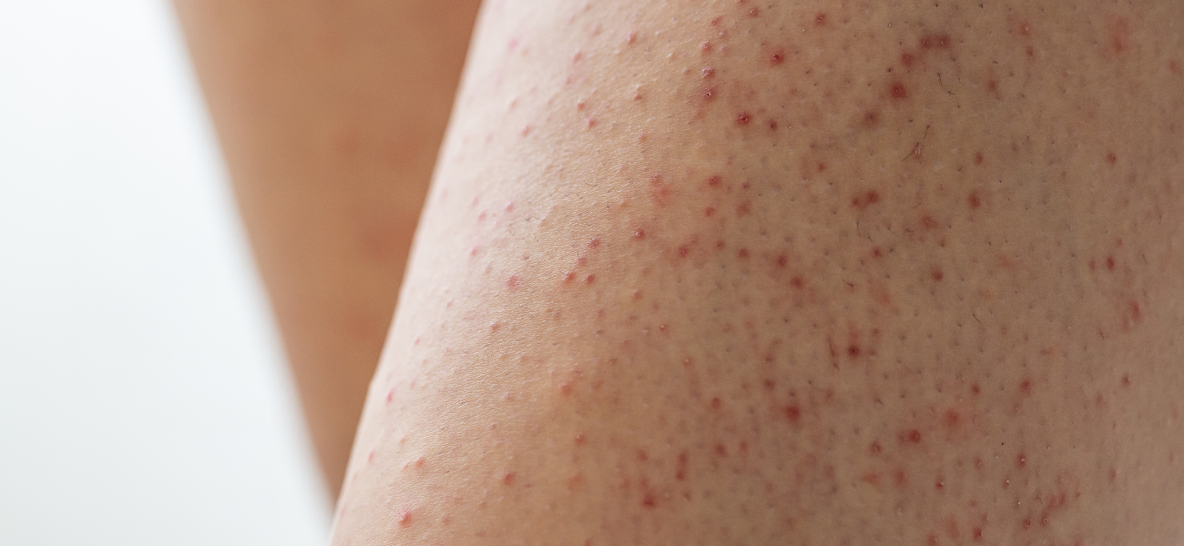 Keratosis Pilaris: Causes, Treatment & What Actually Works