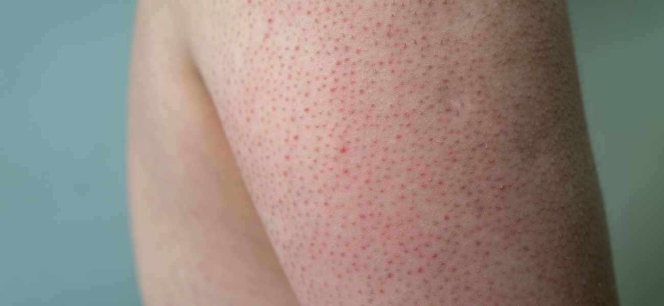 Why Do I Have Tiny Bumps on My Arms? The Science Behind Keratosis Pilaris (KP) and How to Treat It