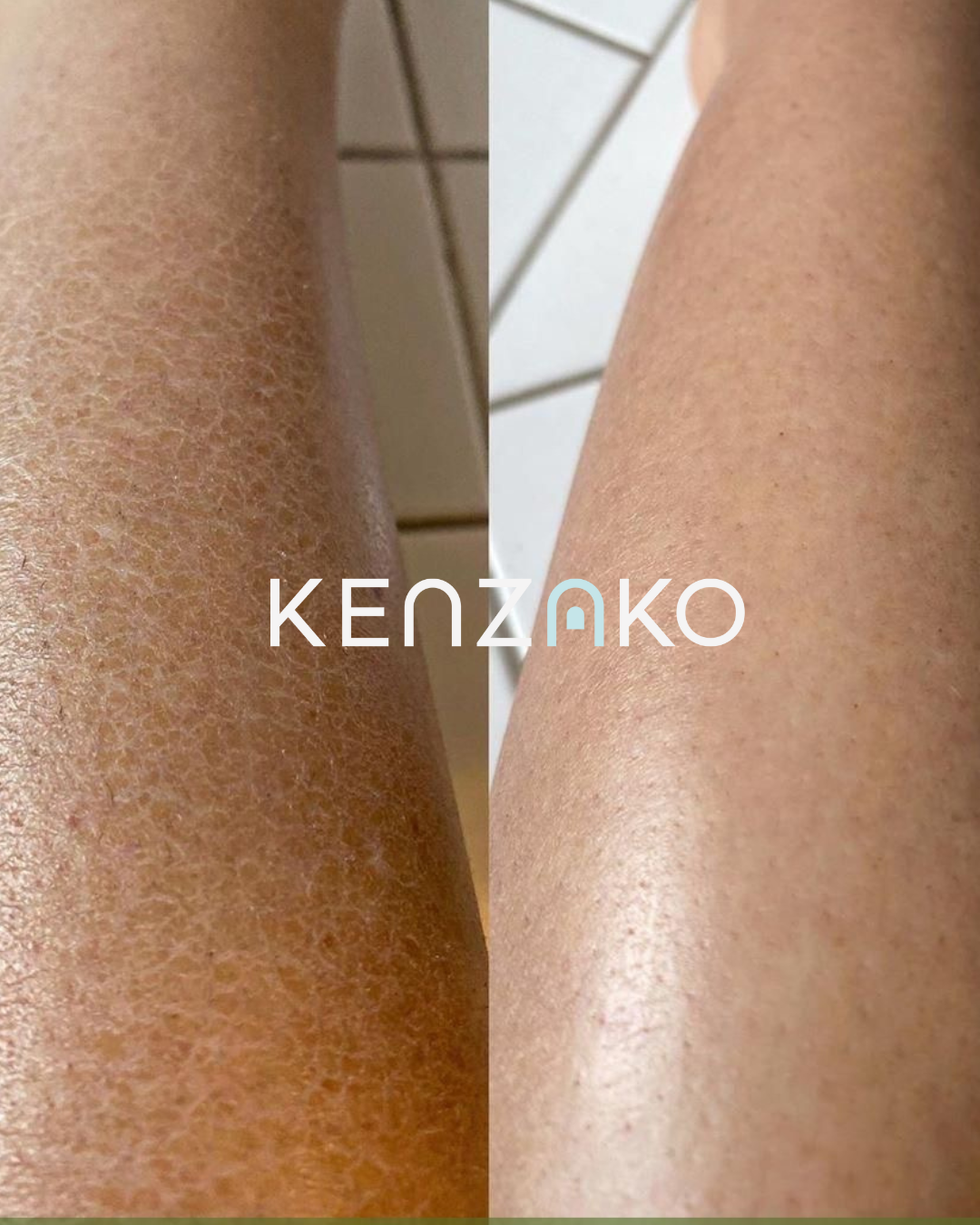 AHA Body Reset Scrub - Exfoliating Body Scrub for Smooth Skin &amp; KP Treatment